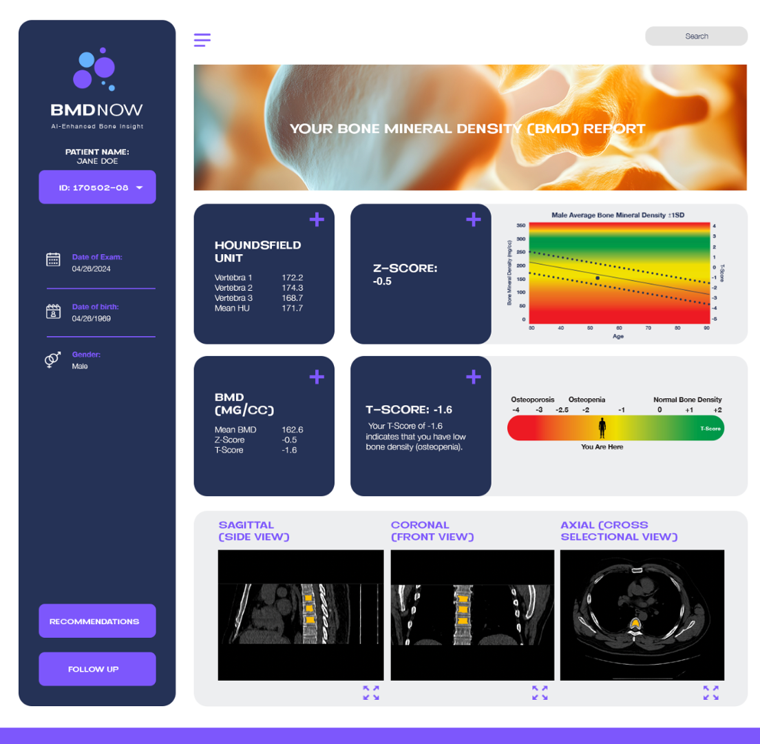 Opportunistic CT Bone Mineral Density (mg/cm³) with DECT and AI: spine and hip analysis example in BMDNow